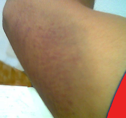 elbow