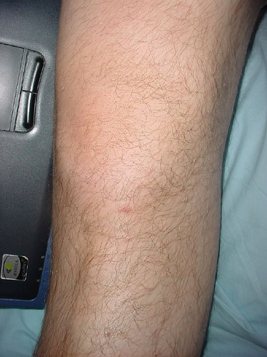 knee