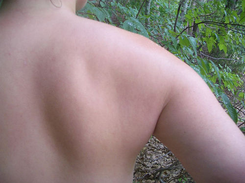 shoulder plaster